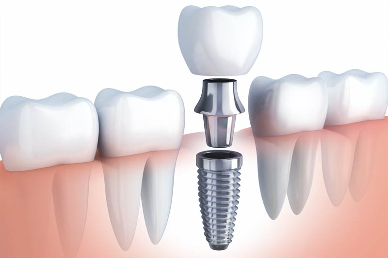 Dental Warranty
 in Meridian